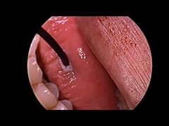 Радиочастотный плазменный генератор для лечения храпа с многофункциональным зондом