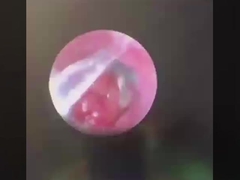 Боттерфлай ОРТ Хирургические инструменты ОРТ Зонд