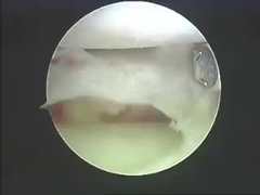 Продукты удаления систем удаления аппаратур Electrosurgical для позвоночника и соединений