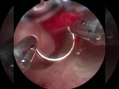 Прохладная технология Плазменная хирургия Электрод для урологии Процедуры ВПЧ