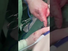 Клинический гепатологический зонд PLA408 для открытой хирургии